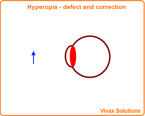 hyperopia defect and correction