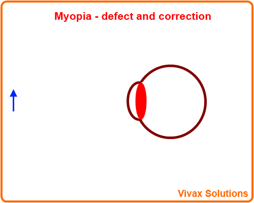 myopia - defects and correction