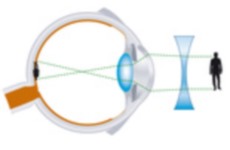 myopia correction